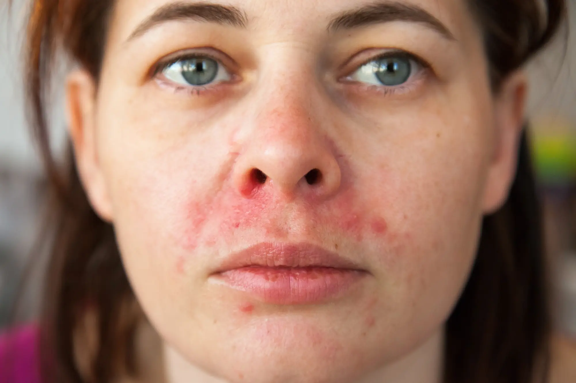 Biltmore Dermatology client with Perioral Dermatitis